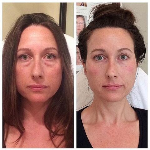 Chicas antes y después del rejuvenecimiento facial con láser. 