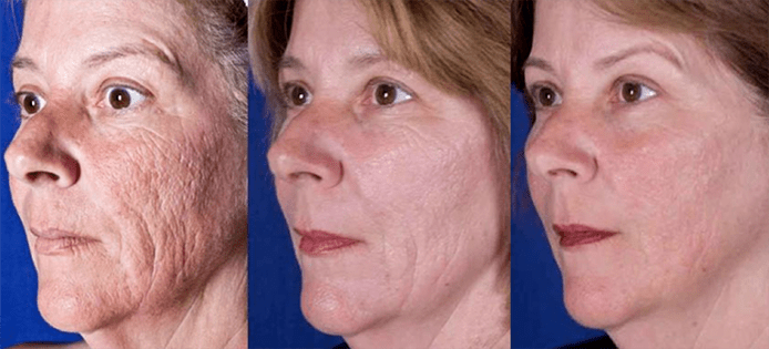 El resultado después de un procedimiento de rejuvenecimiento de la piel facial con láser
