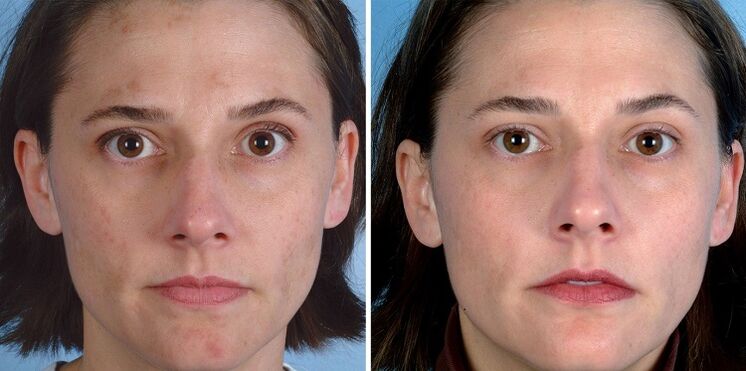 antes y después del rejuvenecimiento de la piel con herramientas