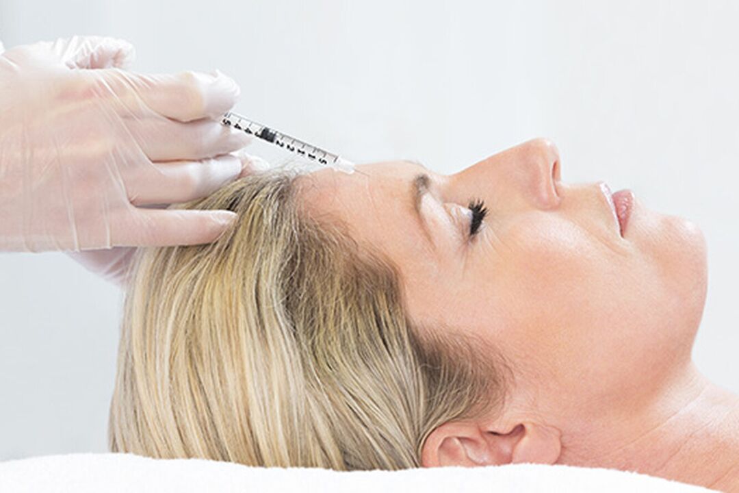 El plasmolifting es un método de inyección para el rejuvenecimiento de la piel del rostro. 