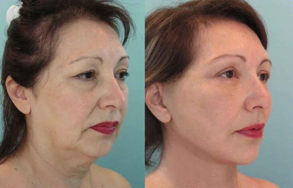 fotos antes y despues del rejuvenecimiento de la piel